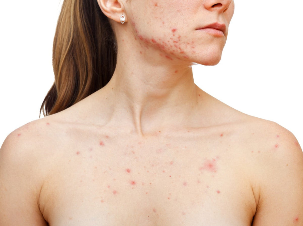 Home Blood Tests and Concerns over the return of ‘old’ diseases as vaccine uptake decreases